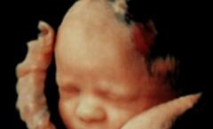 Foto del feto, foto del abdomen, ultrasonido y video sobre el desarrollo del niño.
